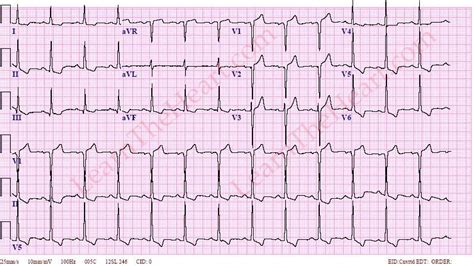 lv wall design|lvh with repolarization abnormalities.